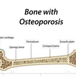 osteoporosis